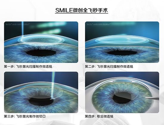 蔡司全飛秒、蔡司半飛秒近視手術(shù)與宇航飛秒的區(qū)別