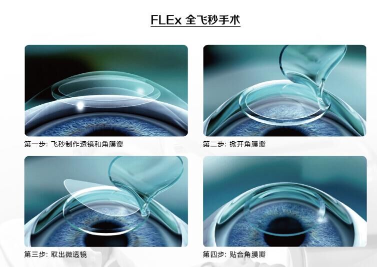 蔡司全飛秒、蔡司半飛秒近視手術(shù)與宇航飛秒的區(qū)別