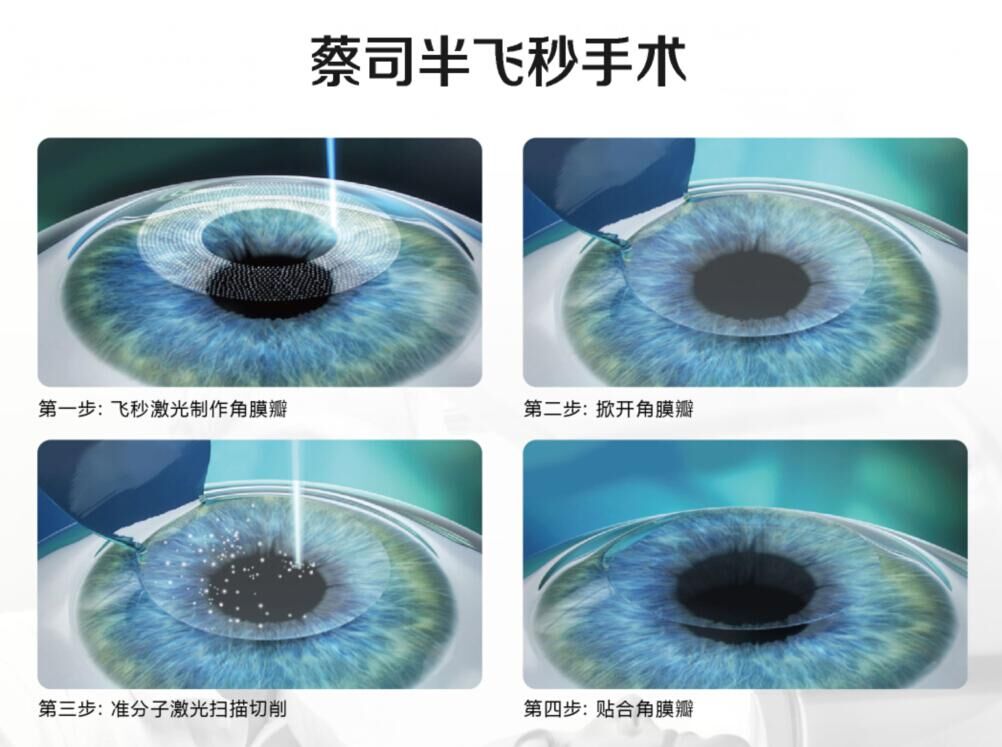 蔡司全飛秒、蔡司半飛秒近視手術(shù)與宇航飛秒的區(qū)別