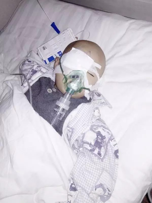 3歲唐氏綜合癥男孩罹患先天性白內(nèi)障，人工晶體植入