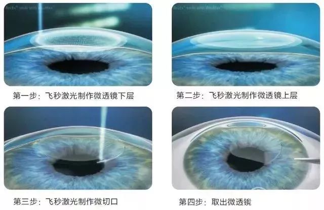 @近視黨，這周天近視手術(shù)交流會(huì)邀你參加