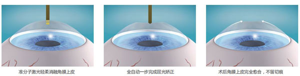 西北首臺千頻阿瑪仕落戶普瑞眼科，近視手術(shù)可以做哦~