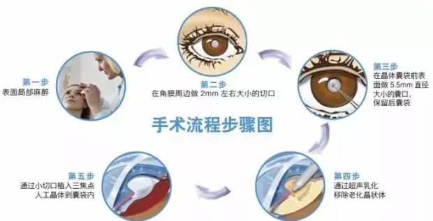 12月23日，普瑞眼科白內(nèi)障患者答謝會邀您參加!